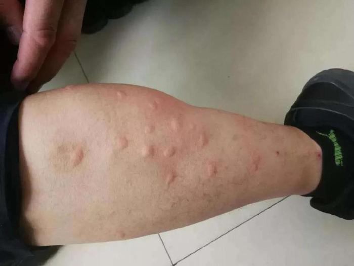 灭花蚊子药_灭蚊子花_杀花蚊子特效药